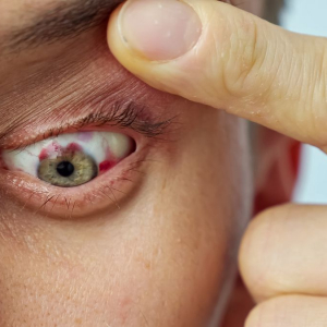 Почему лопаются сосуды в глазах